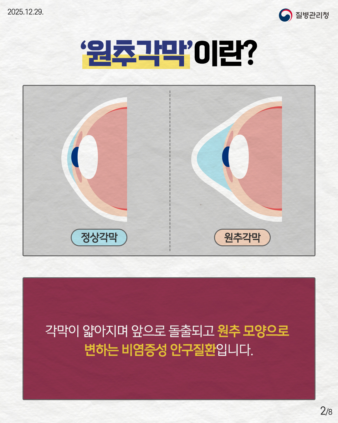 2P '원추각막'이란?  정상각막 원추각막  각막이 얇아지며 앞으로 돌출되고 원추 모양으로 변하는 비염증성 안구질환입니다.