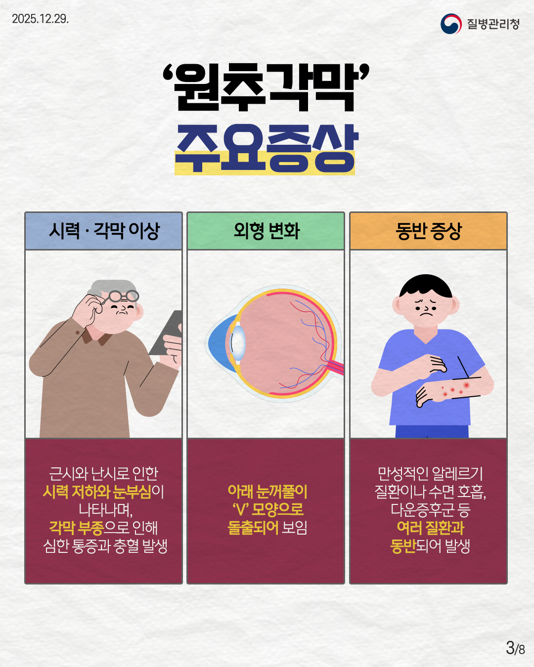 3P '원추각막' 주요증상  시력 &middot; 각막 이상 근시와 난시로 인한 시력 저하와 눈부심이  나타나며, 각막 부종으로 인해 심한 통증과 충혈 발생  외형 변화 아래 눈꺼풀이  'V'모양으로  돌출되어 보임  동반 증상 만성적인 알레르기  질환이나 수면 호흡, 다운증후군 등 여러 질환과 동반되어 발생