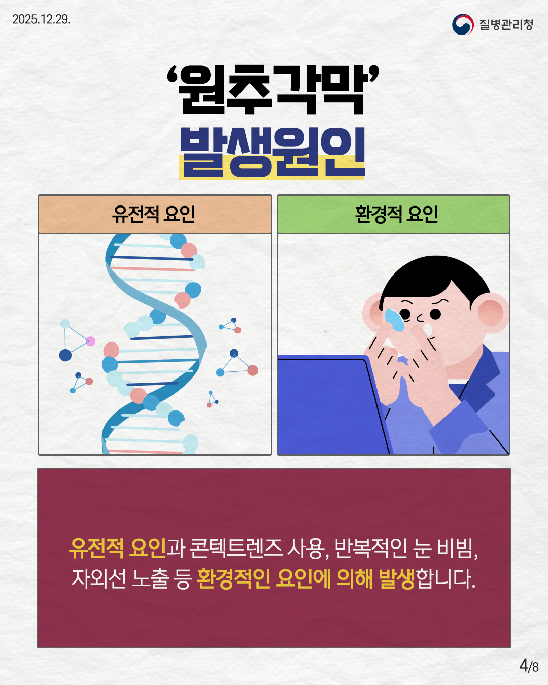 4P '원추각막' 발생원인  유전적 요인과 콘텐트 렌즈 사용, 반복적인 눈 비빔, 자외선 노출 등 환경적인 요인에 의해 발생합니다. 