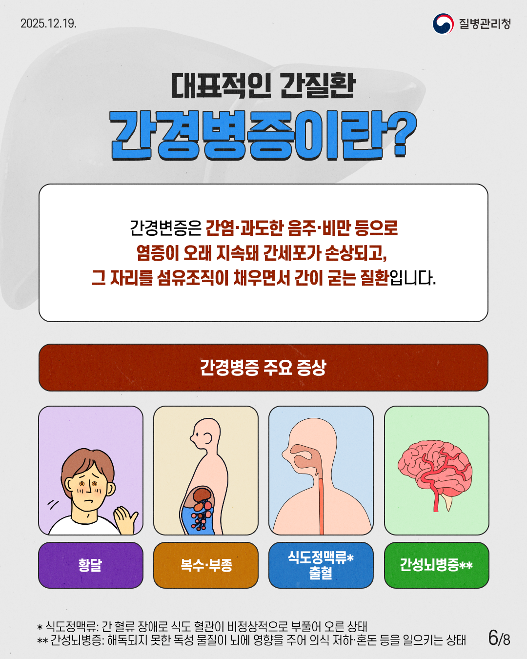 6P 대표적인 간질환 간경병증이란?  간경병증은 간염·과도한 음주·비만 등으로 염증이 오래 지속돼 간세포가 손상되고, 그 자리를 섬유조직이 채우면서 간이 굳는 질환입니다.  간경병증 주요 증상  황달 복수·부종 식도정맥류* 출혈 간성뇌병증**  * 식도정맥류: 간 혈류 장애로 식도 혈관이 비정상적으로 부풀어 오른 상태 ** 간성뇌병증: 해독되지 못한 독성 물질이 뇌에 영향을 주어 의식 저하·혼돈 등을 일으키는 상태