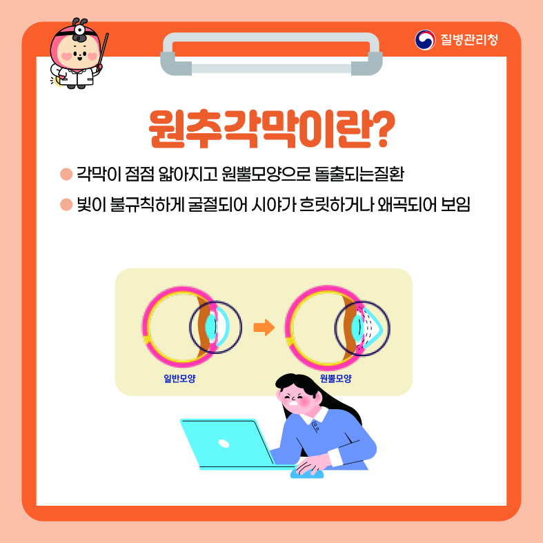 원추각막이란? - 각막이 점점 얇아지고 원뿔모양으로 돌출되는질환  - 빛이 불규칙하게 굴절되어 시야가 흐릿하거나 왜곡되어 보임