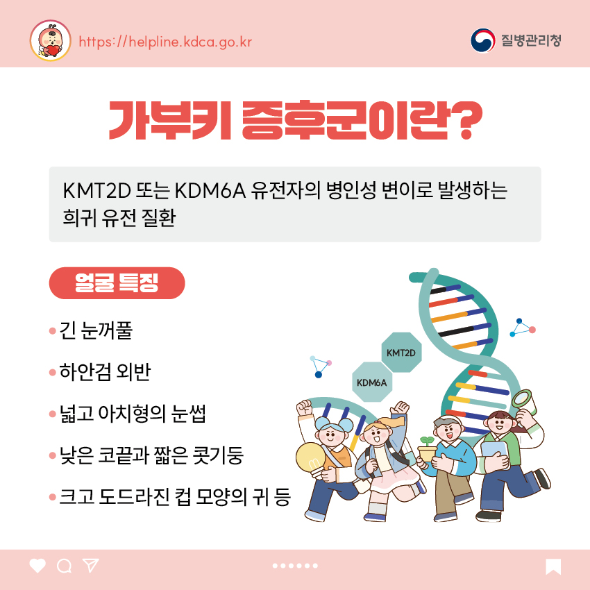 가부키 증후군이란? - KMT2D 또는 KDM6A 유전자의 병인성 변이로 발생하는 희귀 유전 질환 <얼굴 특징> - 긴 눈꺼풀 - 하안검 외반 - 넓고 아치형의 눈썹 - 낮은 코끝과 짧은 콧기둥 - 크고 도드라진 컵 모양의 귀 등