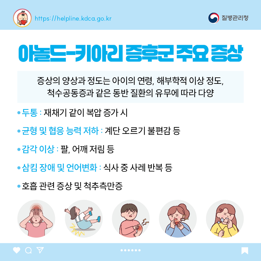 아놀드-키아리 증후군 주요 증상 - 증상의 양상과 정도는 아이의 연령, 해부학적 이상 정도, 척수공동증과 같은 동반 질환의 유무에 따라 다양 - 두통 : 재채기 같이 복압 증가 시 - 균형 및 협응 능력 저하 : 계단 오르기 불편감 등 - 감각 이상 : 팔, 어깨 저림 등 - 삼킴 장애 및 언어변화 : 식사 중 사레 반복 등 - 호흡 관련 증상 및 척추측만증