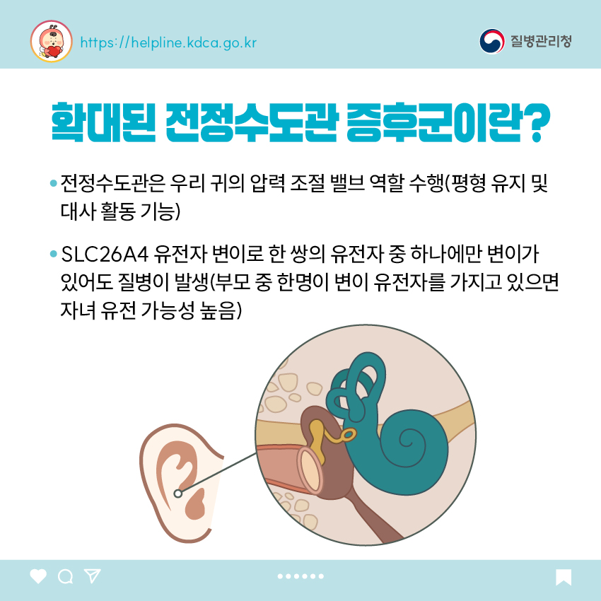 확대된 전정수도관 증후군이란? - 전정수도관은 우리 귀의 압력 조절 밸브 역할 수행(평형 유지 및 대사 활동 기능) - SLC26A4 유전자 변이로 한 쌍의 유전자 중 하나에만 변이가 있어도 질병이 발생(부모 중 한명이 변이 유전자를 가지고 있으면 자녀 유전 가능성 높음)