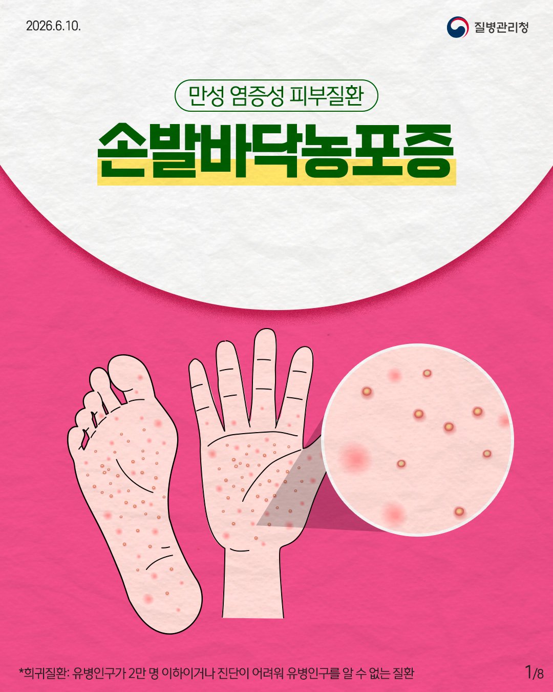 만성 염증성 피부질환 손발바닥농포증  *희귀질환: 유병인구가 2만 명 이하이거나 진단이 어려워 유병인구를 알 수 없는 질환