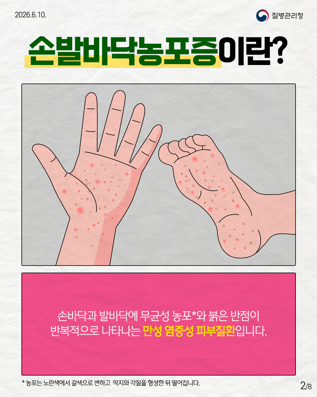 손발바닥농포증이란?  손바닥과 발바닥에 무균성 농포*와 붉은 반점이 반복적으로 나타나는 만성 염증성 피부질환입니다.  * 농포는 노란색에서 갈색으로 변하고 딱지와 각질을 형성한 뒤 떨어집니다.