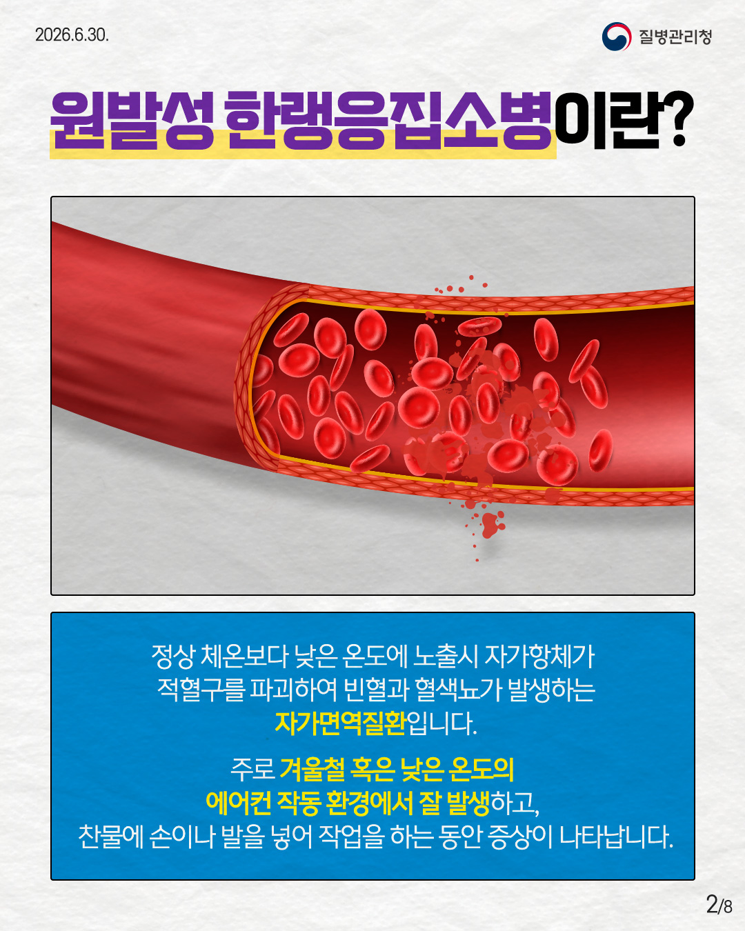 2페이지 원발성 한랭응집소병이란? 정상 체온보다 낮은 온도에 노출시 자가항체가 적혈구를 파괴하여 빈별화 혈색뇨가 발생하는 자가면역질환입니다. 주로 겨울철 혹은 낮은 온도의 에어컨 작동 환경에서 잘 발생하고, 찬물에 손이나 발을 넣어 작업을 하는 동안 증상이 나타납니다.