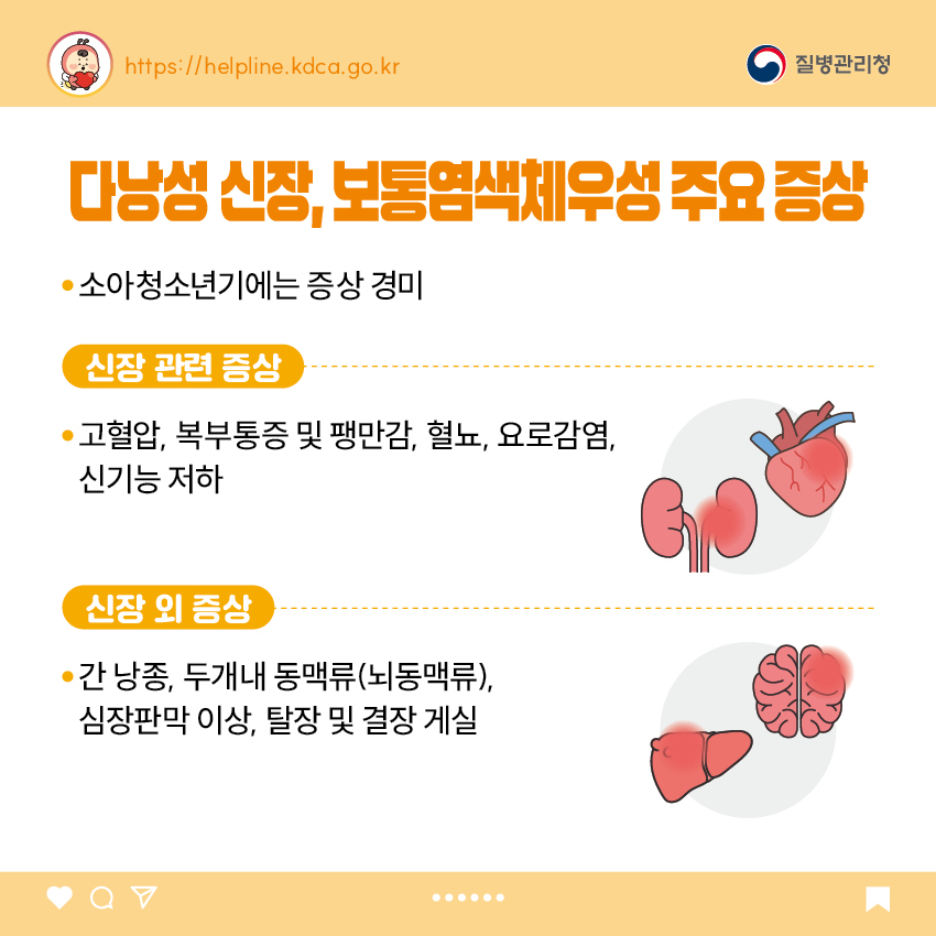 2. 다낭성 신장, 보통염색체우성 주요 증상 - 소아청소년기에는 증상 경미 <신장 관련 증상> - 고혈압, 복부통증 및 팽만감, 혈뇨, 요로감염, 신기능 저하 <신장 외 증상> - 간 낭종, 두개내 동맥류(뇌동맥류), 심장판막 이상, 탈장 및 결장 게실