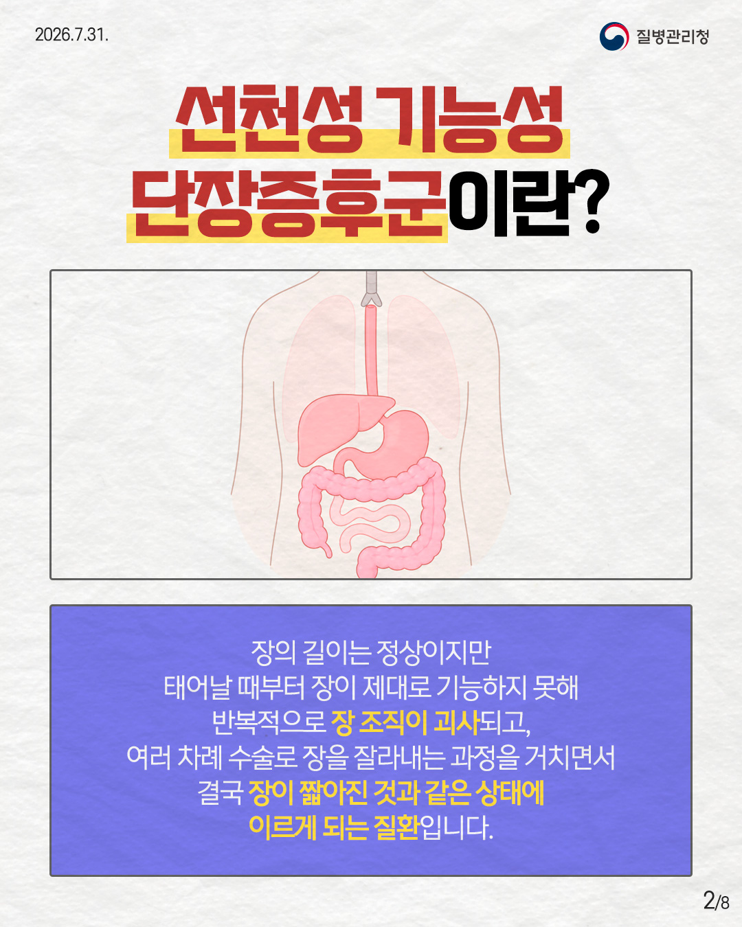 2페이지 선천성 기능성 단장증후군이란? 장의 길이는 정상이지만 태어날 때부터 장이 제대로 기능하지 못해 반복적으로 장 조직이 괴사되고, 여러 차례 수술로 장을 잘라내는 과정을 거치면서 결국 장이 짧아진 것과 같은 상태에 이르게 되는 질환입니다. 2/8