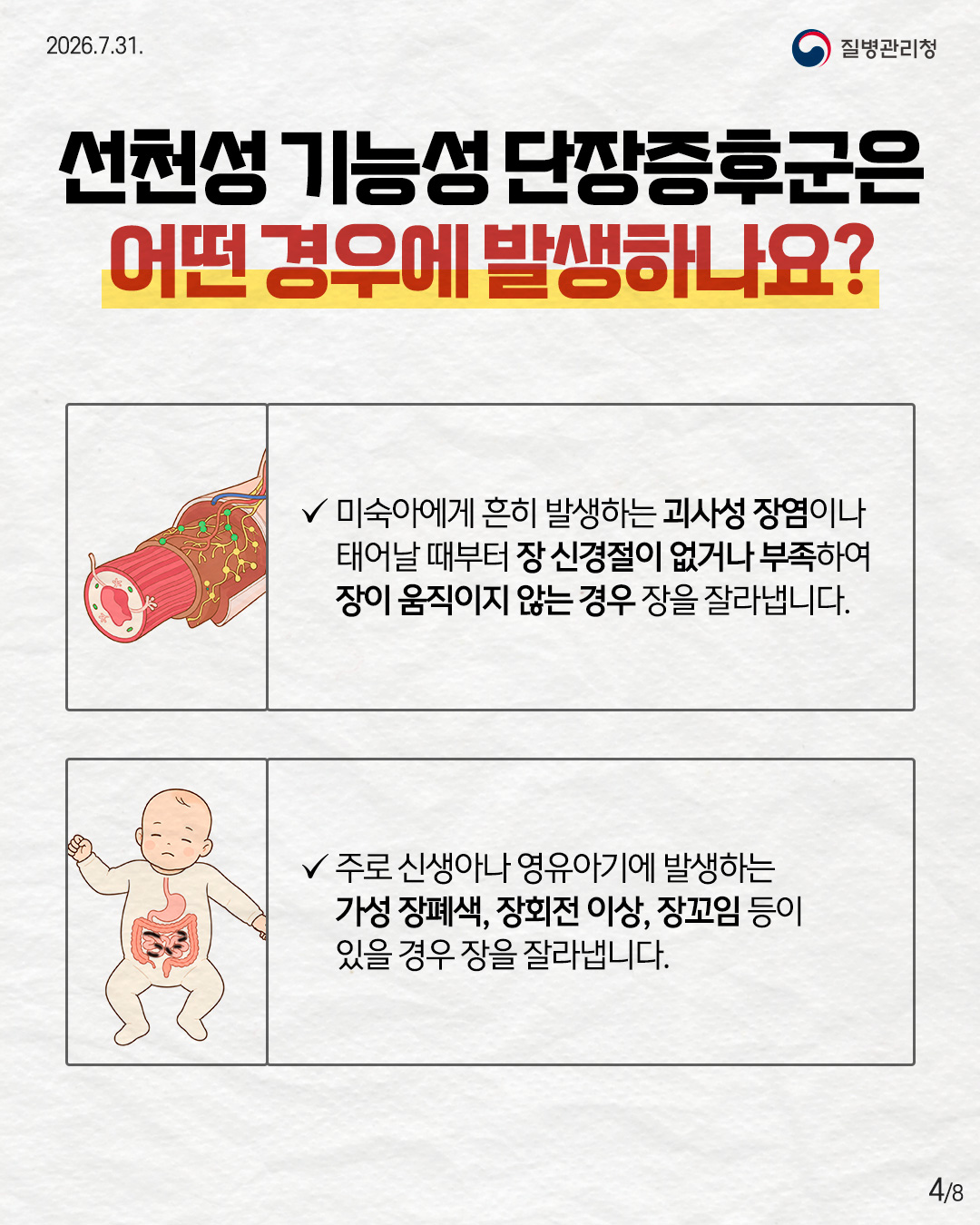 4페이지 선천성 기능성 단장증후군은 어떤 경우에 발생하나요? 미숙아에게 흔히 발생하는 괴사성 장염이나 태어날 때부터 장 신경절이 없거나 부족하여 장이 움직이지 않는 경우 장을 잘라냅니다. 주로 신생아나 영유아기에 발생하는 가성 장폐색, 장회전 이상, 장꼬임 등이 있을 경우 장을 잘라냅니다. 4/8