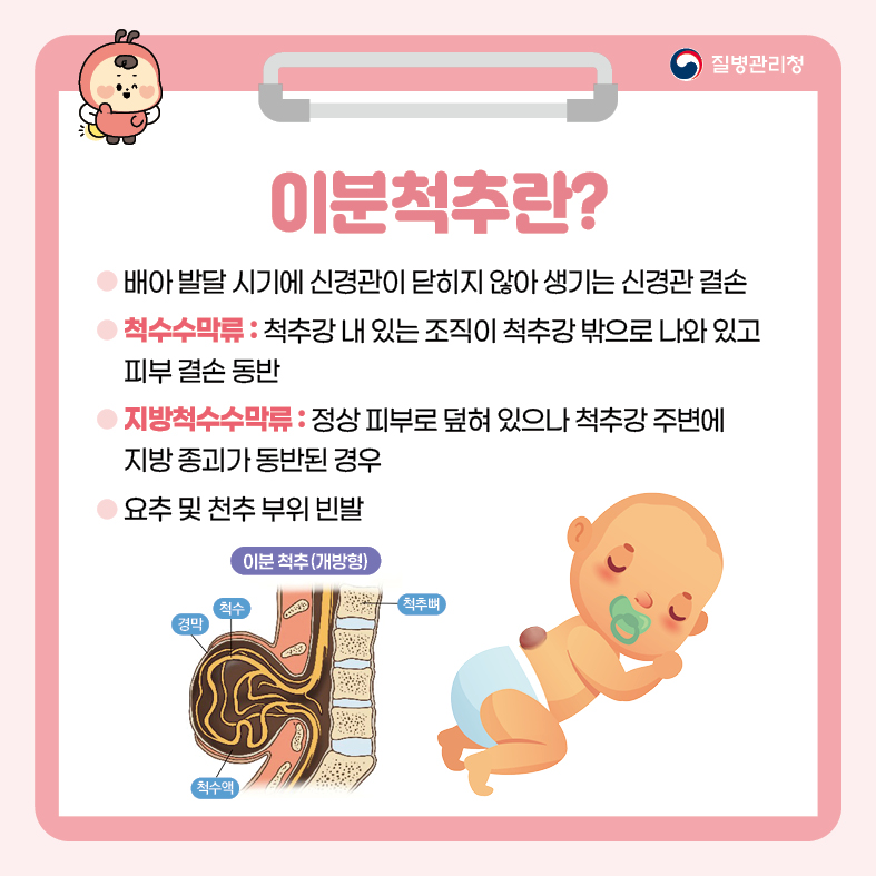 이분척추란?
- 배아 발달 시기에 신경관이 닫히지 않아 생기는 신경관 결손 
- 척수수막류 : 척추강 내 있는 조직이 척추강 밖으로 나와 있고 피부 결손 동반
- 지방척수수막류 : 정상 피부로 덮혀 있으나 척추강 주변에 지방 종괴가 동반된 경우
- 요추 및 천추 부위 빈발