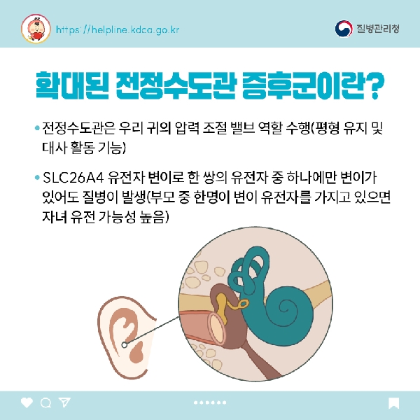 확대된 전정수도관 증후군이란? - 전정수도관은 우리 귀의 압력 조절 밸브 역할 수행(평형 유지 및 대사 활동 기능) - SLC26A4 유전자 변이로 한 쌍의 유전자 중 하나에만 변이가 있어도 질병이 발생(부모 중 한명이 변이 유전자를 가지고 있으면 자녀 유전 가능성 높음)