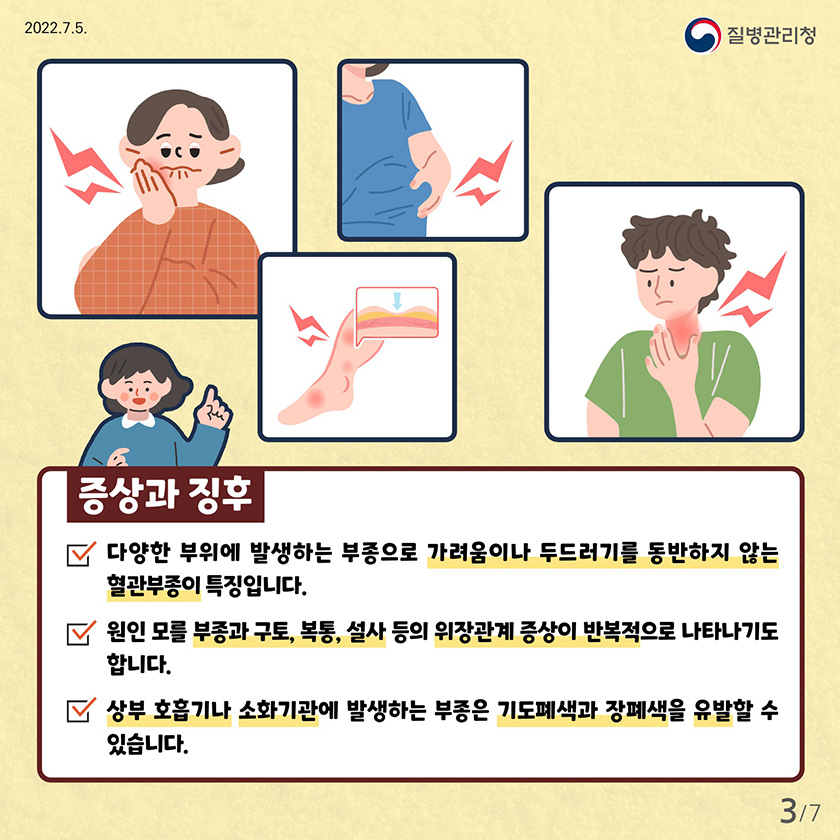 다양한 부위에 발생하는 부종으로 가려움이나 두드러기를 동반하지 않는 혈관부종이 특징입니다.원인 모를 부종과 구토, 복통, 설사 등의 위장관계 증상이 반복적으로 나타나기도 합니다. 상부 호흡기나 소화기관에 발생하는 부종은 기도폐색과 장폐색을 유발할 수 있습니다.