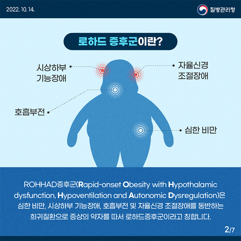 ROHHAD증후군(Rapid-onset Obesity with Hypothalamic dysfunction, Hypoventilation and Autonomic Dysregulation)은 심한 비만, 시상하부 기능장애, 호흡부전 및 자율신경 조절장애를 동반하는 희귀질환으로 증상의 약자를 따서 로하드증후군이라고 칭합니다.