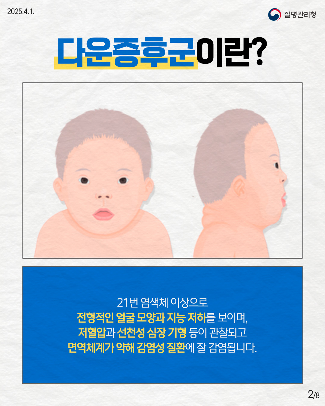 다운증후군이란?  21번 염색체 이상으로 전형적인 얼굴 모양과 지능 저하를 보이며, 저혈압과 선천성 심장 기형 등이 관찰되고 면역체계가 약해 감염성 질환에 잘 감염됩니다.