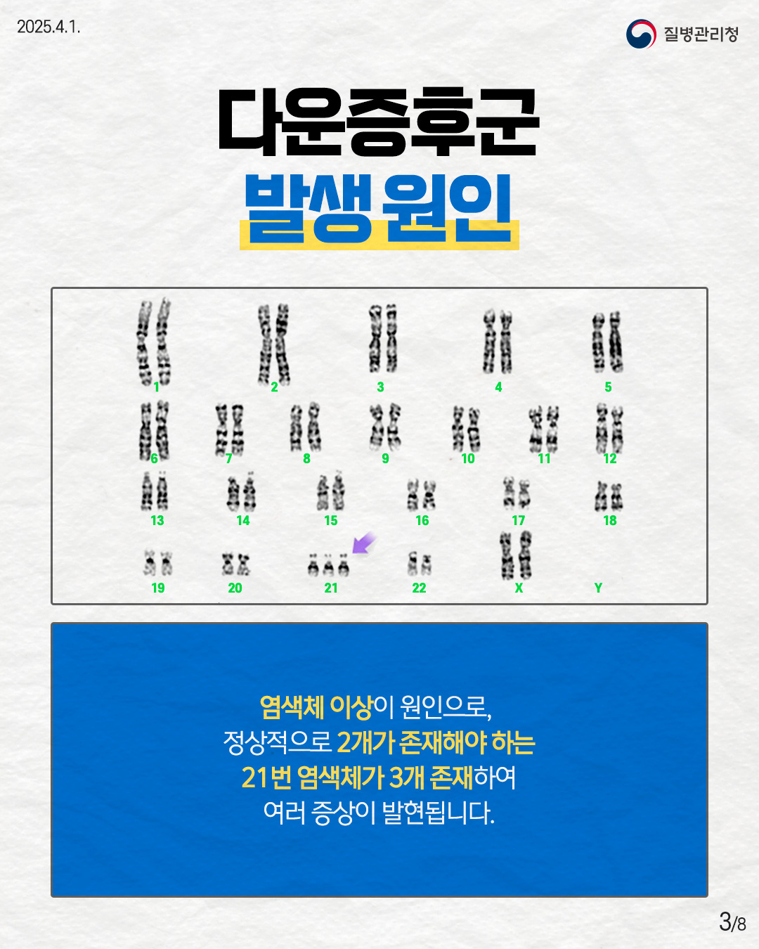 다운증후군 발생원인  염색체 이상이 원인으로, 정상적으로 2개가 존재해야 하는 21번 염색체가 3개 존재하여 여러 증상이 발현됩니다.