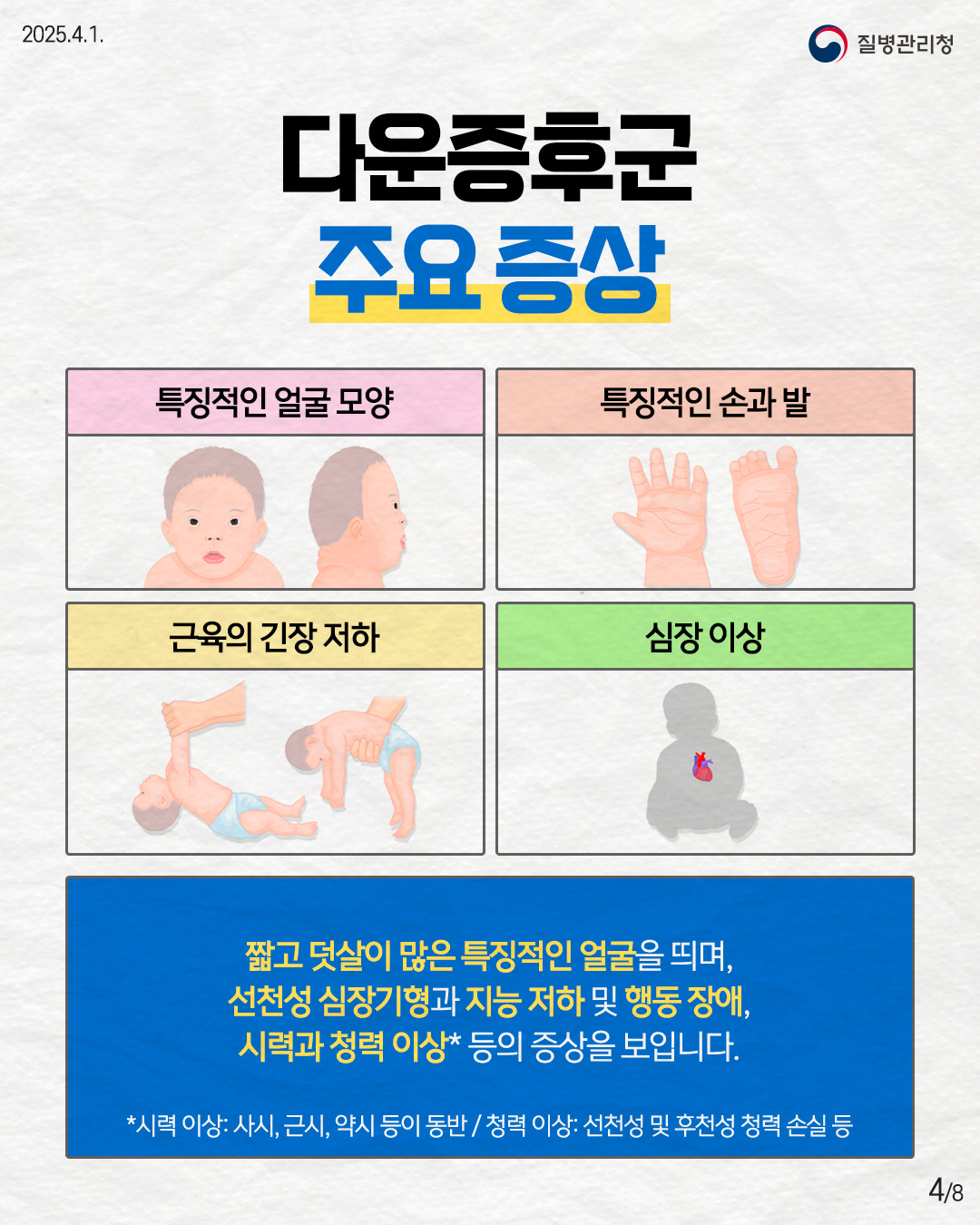 다운증후군 주요 증상  - 특징적인 얼굴 모양 - 특징적인 손과 발 - 근육의 긴장 저하 - 심장 이상  짧고 덧살이 많은 특징적인 얼굴을 띄며, 선천성 심장기형과 지능 저하 및 행동 장애, 시력과 청력 이상* 등의 증상을 보입니다.  *시력: 사시, 근시, 약시 등이 동반 청력: 선천성 및 후천성 청력 손실 등