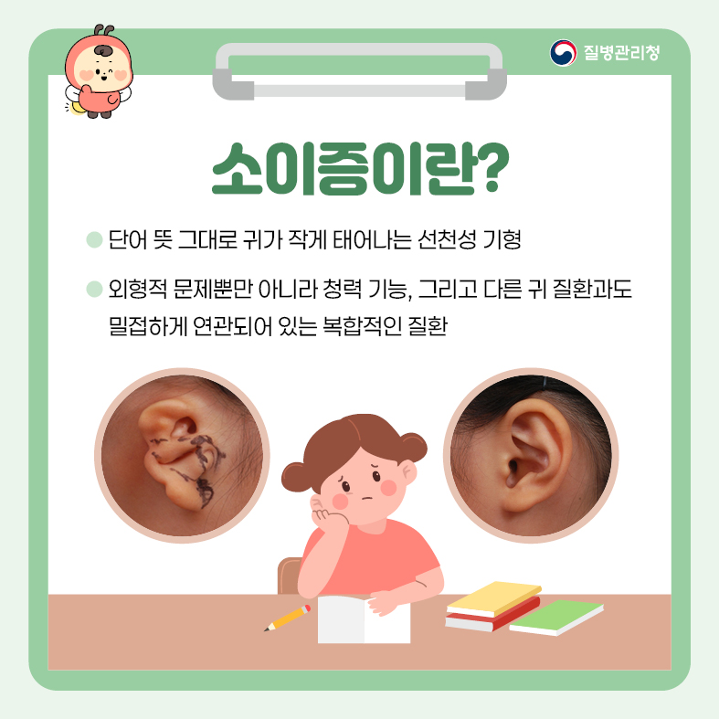 소이증이란? - 단어 뜻 그대로 귀가 작게 태어나는 선천성 기형 - 외형적 문제뿐만 아니라 청력 기능, 그리고 다른 귀 질환과도 밀접하게 연관되어 있는 복합적인 질환