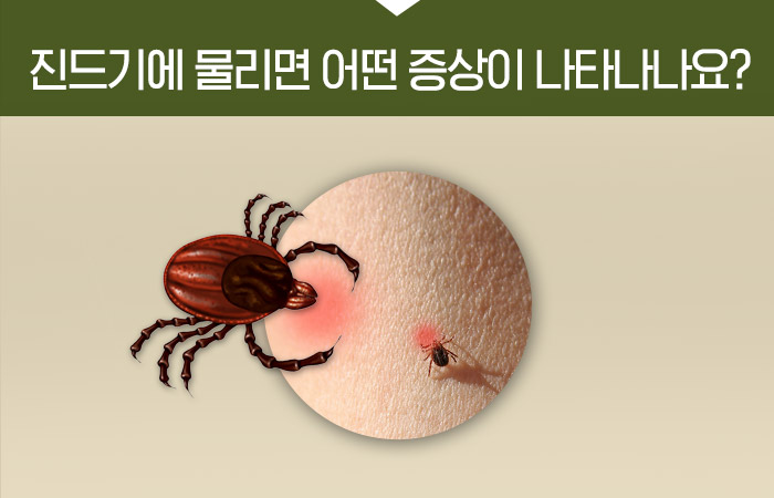 진드기에 물리면 어떤 증상이 나타나나요?