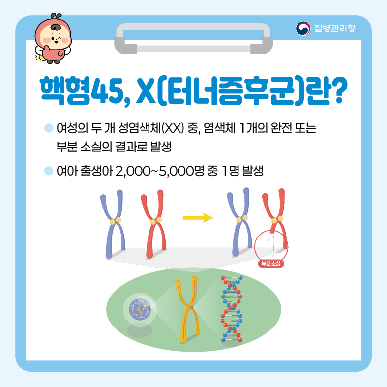 핵형45, X(터너 증후군)